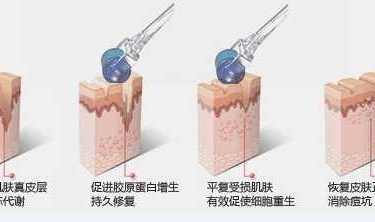 微创水光针