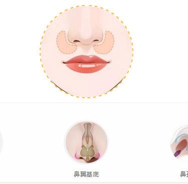 假体垫鼻基底