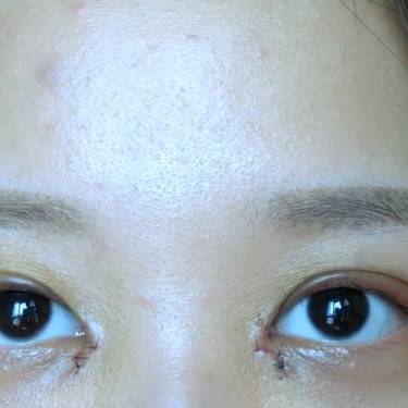全切去皮去脂开内眼角术后七天全分享