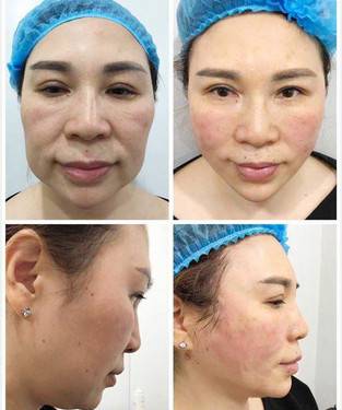 悦升线埋线还有美白的功效吗