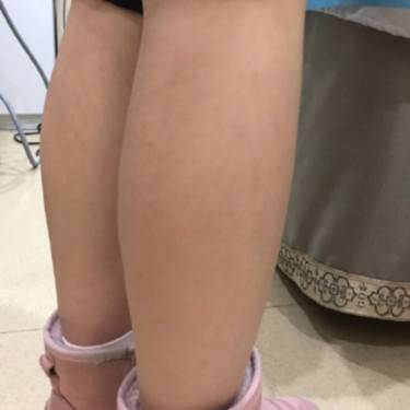 注射塑形腿部