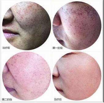 皮秒激光