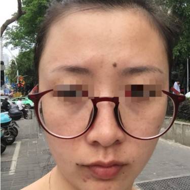 皮秒激光