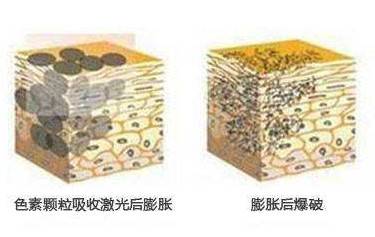 皮秒激光