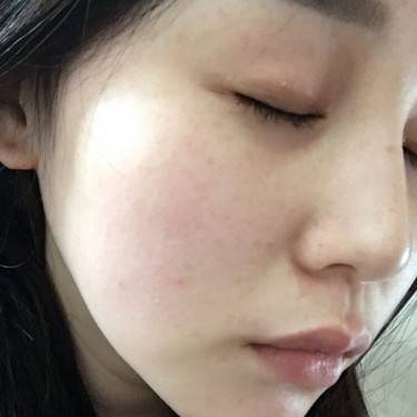 皮秒激光