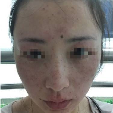 皮秒激光