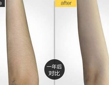 激光脱毛