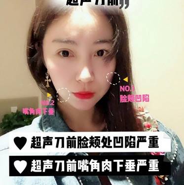 超声提升