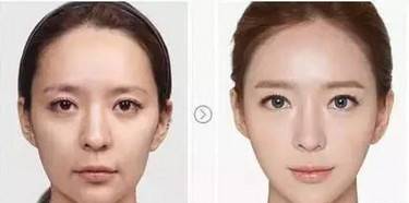 超声提升