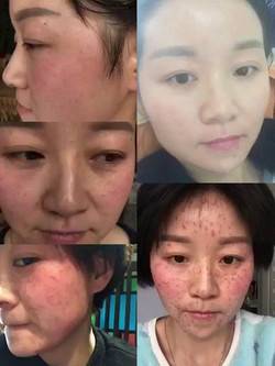 皮秒激光
