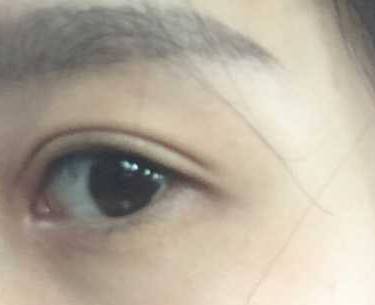 开眼角
