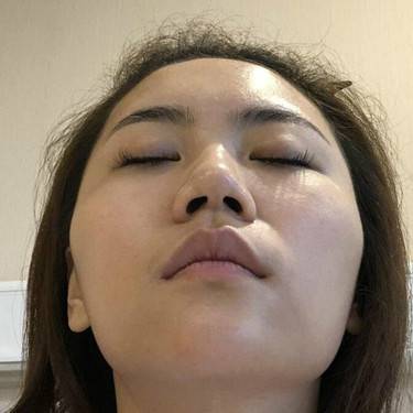 下颌角整形