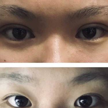 开眼角