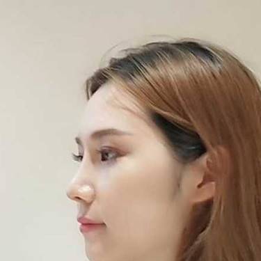 耳软骨隆鼻