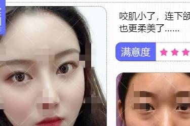 除皱瘦脸