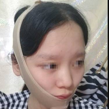 下颌角整形