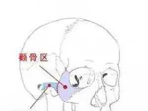 颧骨颧弓整形