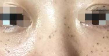激光淡斑