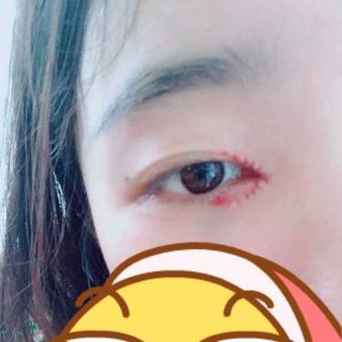 开眼角