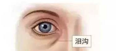 玻尿酸泪沟