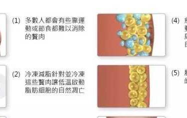 冷冻溶脂