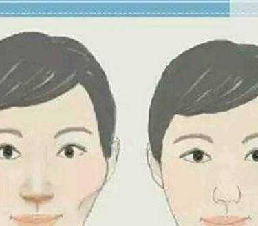 颧骨颧弓整形