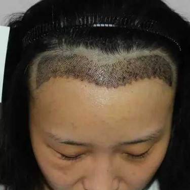 植发际线