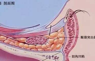 玻尿酸泪沟