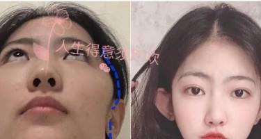 下颌角整形