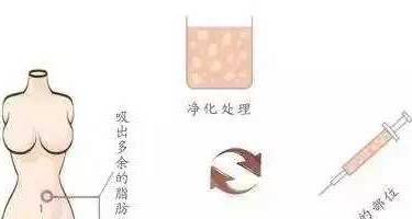 玻尿酸泪沟