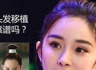 植发际线