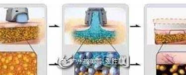 冷冻溶脂