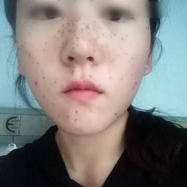 激光淡斑