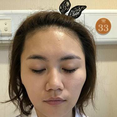 下颌角整形
