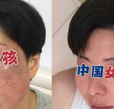 激光淡斑
