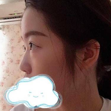 耳软骨隆鼻