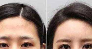 除皱