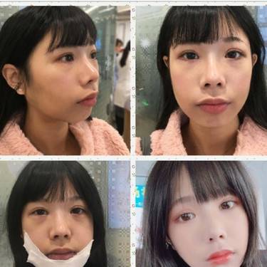 硅胶垫下巴
