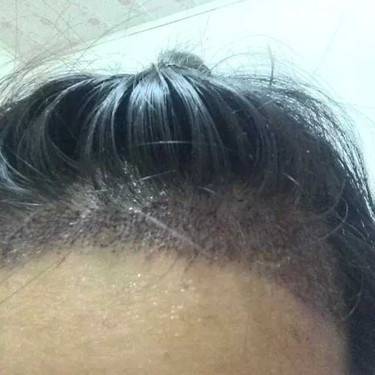 植发际线