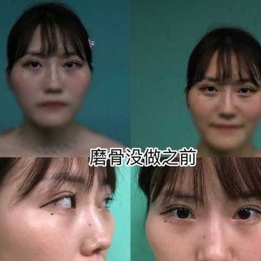 下颌角整形
