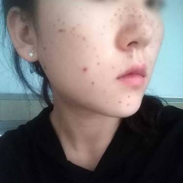 激光淡斑