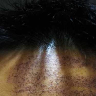 激光祛斑的原理是什么它怎么做到祛斑而不伤害或者灼伤