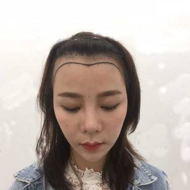 植发际线
