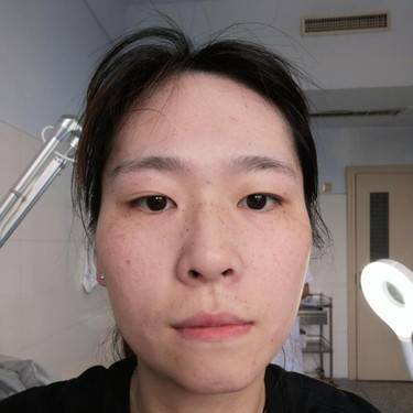 激光淡斑