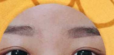 开眼角