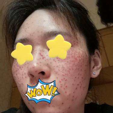 激光淡斑
