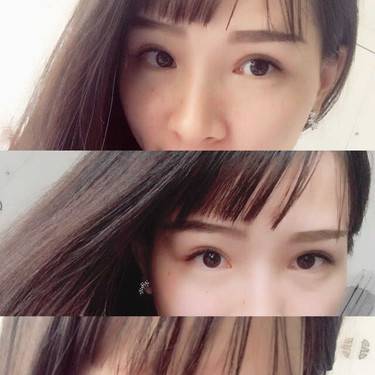 开眼角