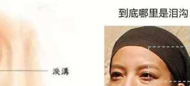 祛黑眼圈