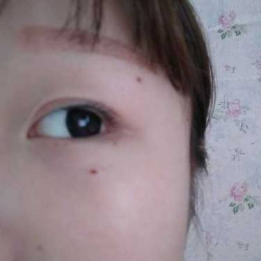激光点痣