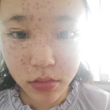 激光淡斑